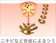 ニキビなど炎症によるシミ