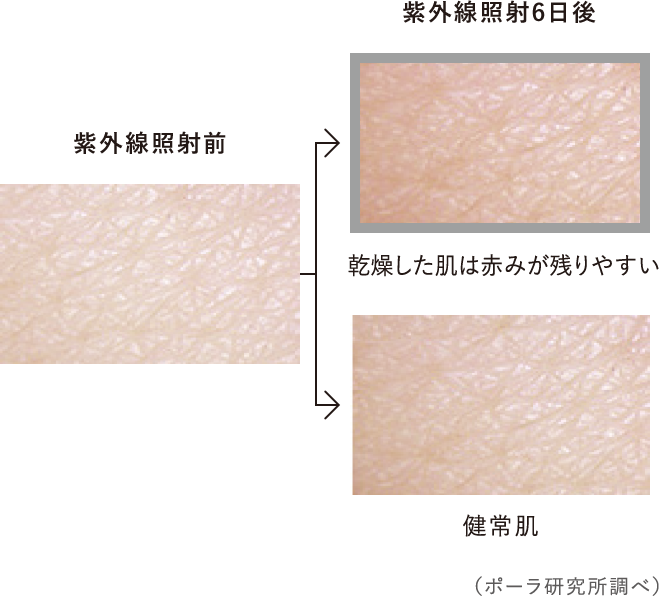 紫外線照射前 紫外線照射6日後 乾燥した肌は赤みが残りやすい 健常肌