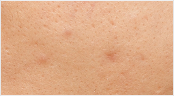 初期ニキビ（炎症を起こしていないニキビ）