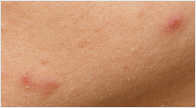 炎症を起こしたニキビ