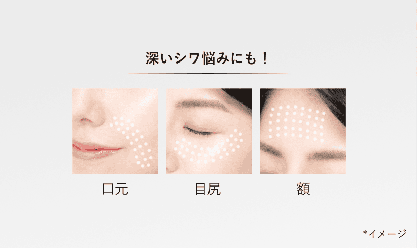 深いシワ悩みにも！ 口元 目尻 額 *イメージ