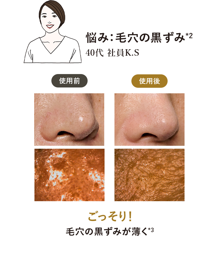 slide2 悩み：毛穴の黒ずみ*2 ごっそり！毛穴の黒ずみが薄く*3