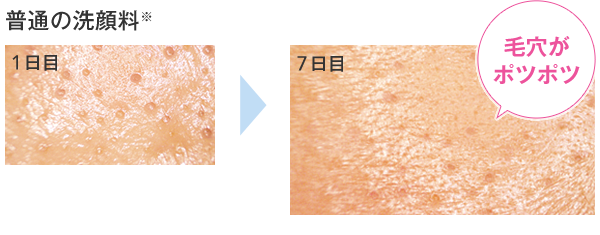 普通の洗顔料※ 1日目 7日目毛穴がポツポツ