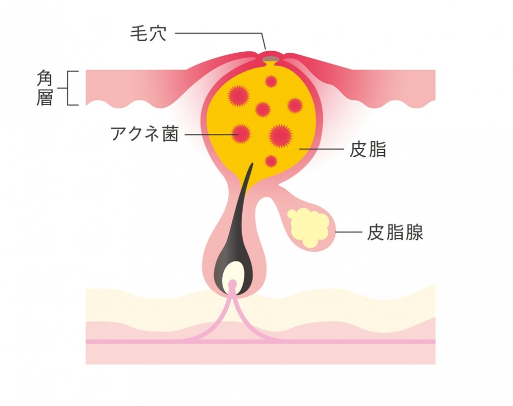 大人のためのニキビケア 1 原因とメカニズム 美容のプロに聞いてみました 読み物 日々をここちよく 化粧品 スキンケア 基礎化粧品の通販 オルビス 公式オンラインショップ