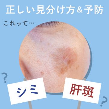 気になるその影、本当に“シミ”？ シミと肝斑の見分け方＆予防策